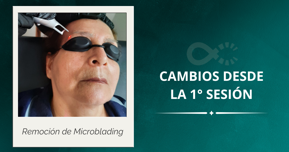 Eliminacion de tatuajes-lasser picosegundos-cleenink-ciudad de m&eacute;xico